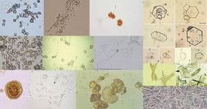 What are the types of Crystals found in Urine? Types-of-Crystals-in-Urine