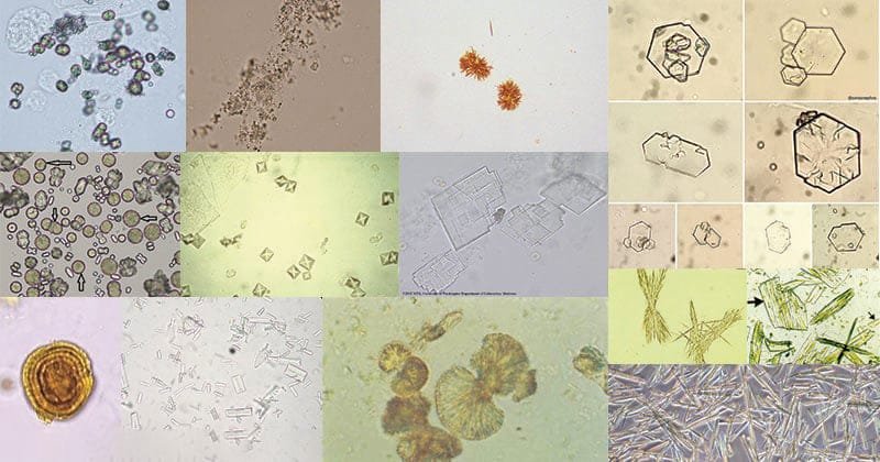 Types-of-Crystals-in-Urine