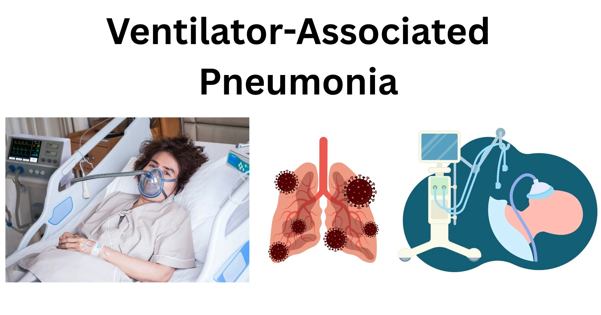 Ventilator-Associated-Pneumonia
