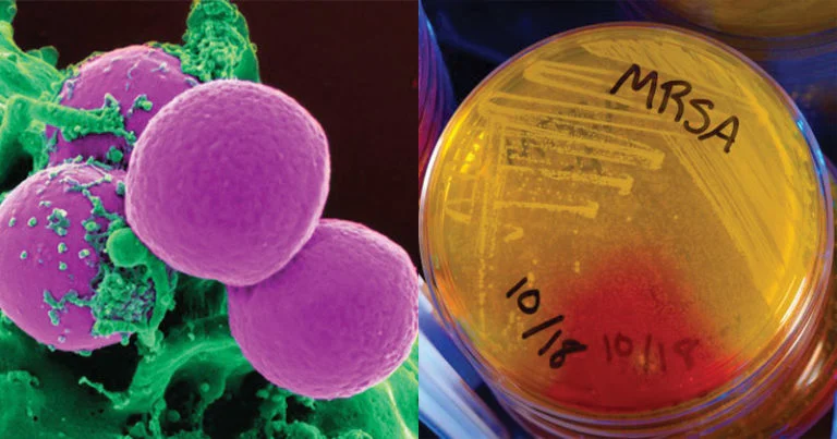 Methicillin-Resistant-Staphylococcus-aureus-MRSA-768x403